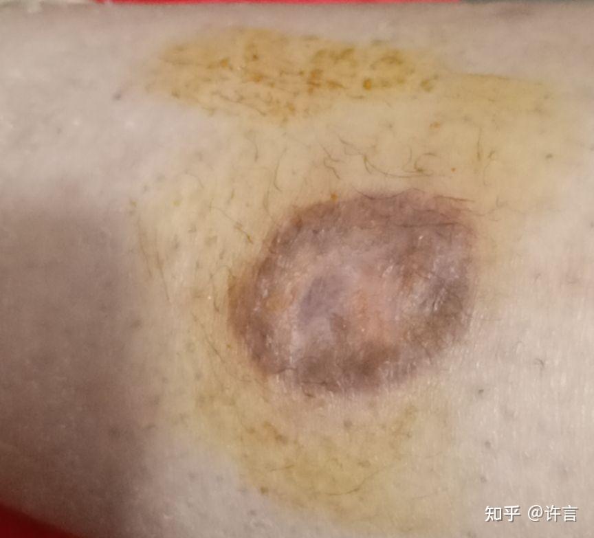 低温烫伤恢复过程