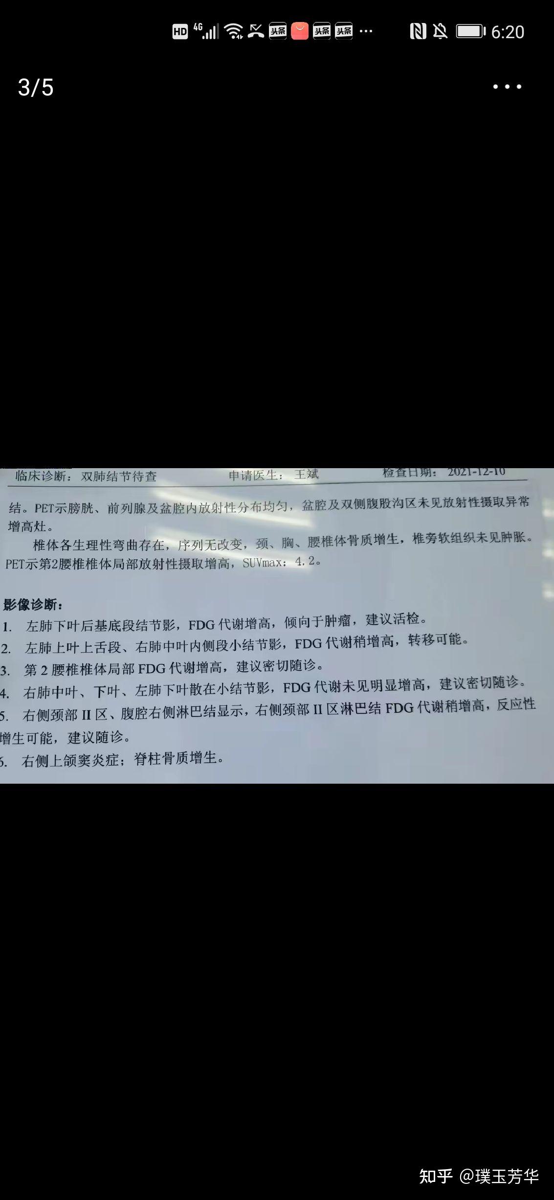 从肺磨玻璃结节影到晚期肺癌最快有多快随访中会出现高危因素吗