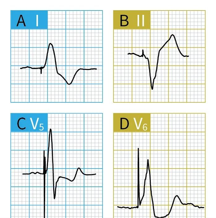 单腔起搏器心电图图片