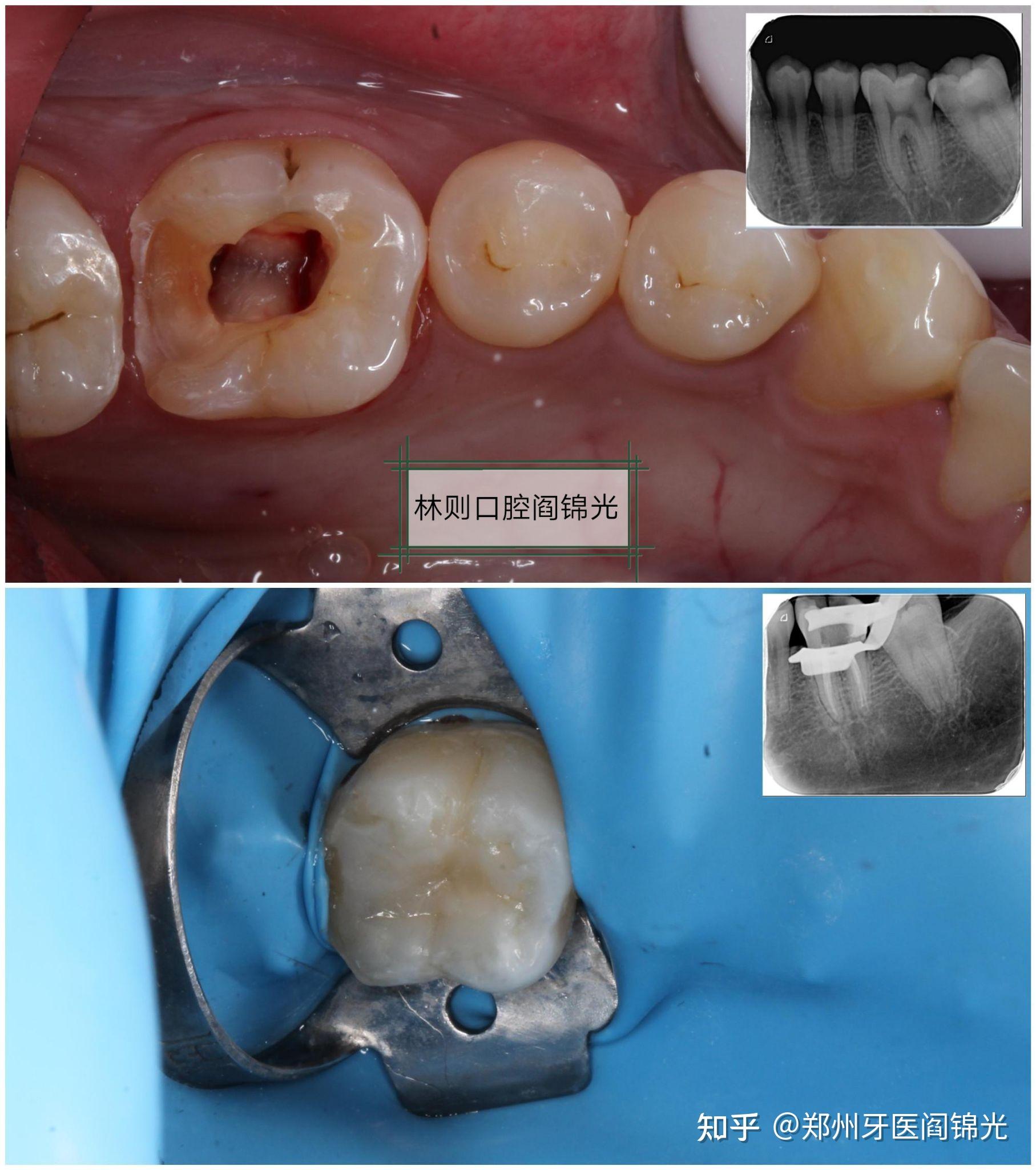 年轻恒牙根管治疗树脂充填补牙