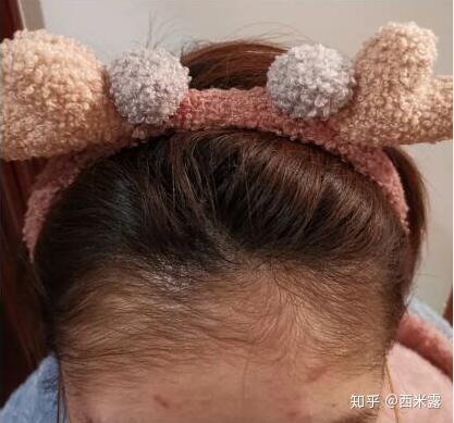 怎么弄出鞠婧祎这种的发际线的胎毛?