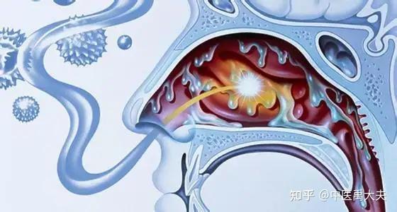 鼻窦炎要根据情况