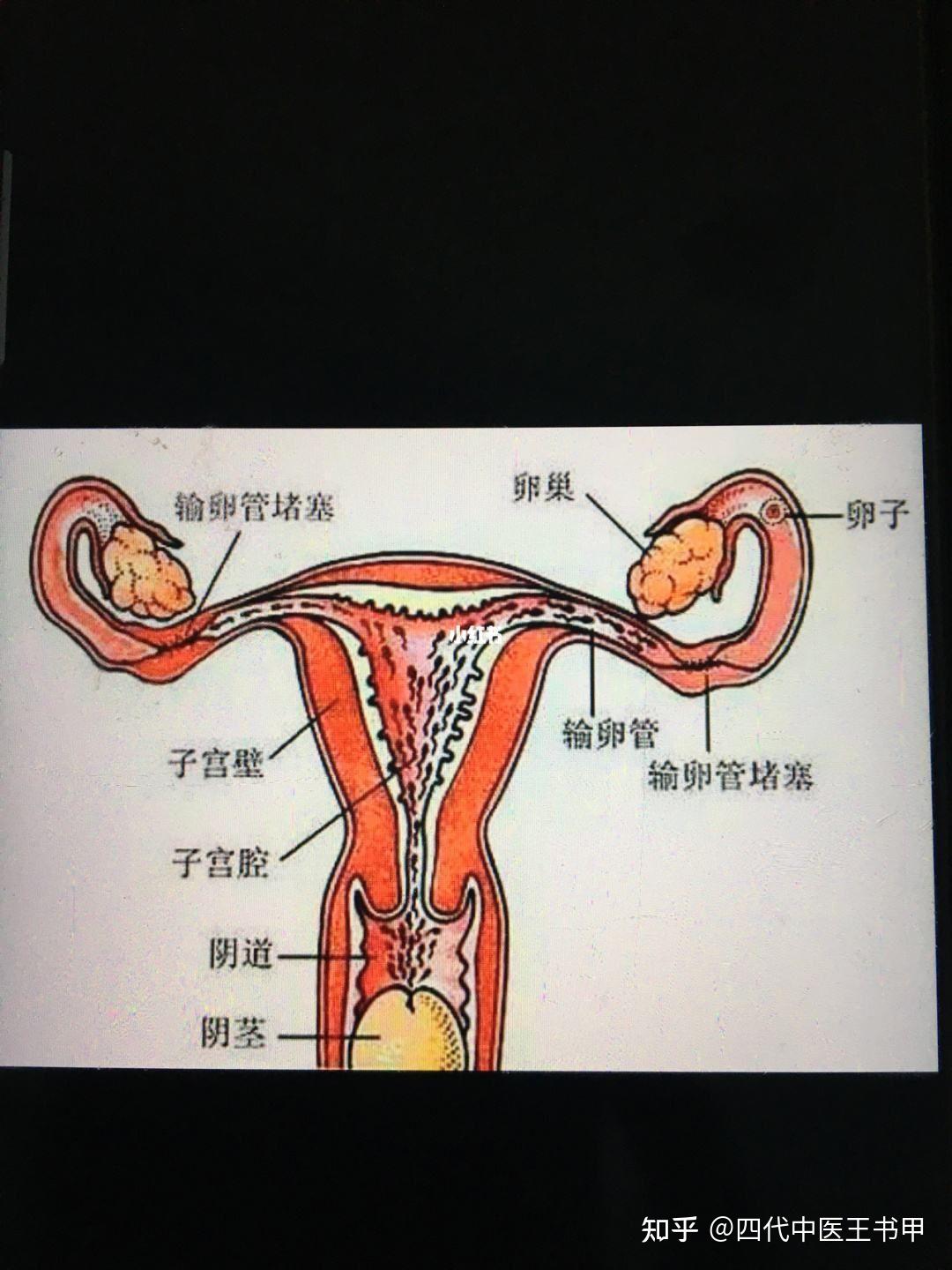 输卵管堵塞引起的不孕