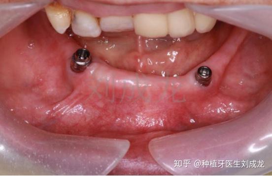 郑州半口全口种植牙哪家医院种植医生种的好种的多