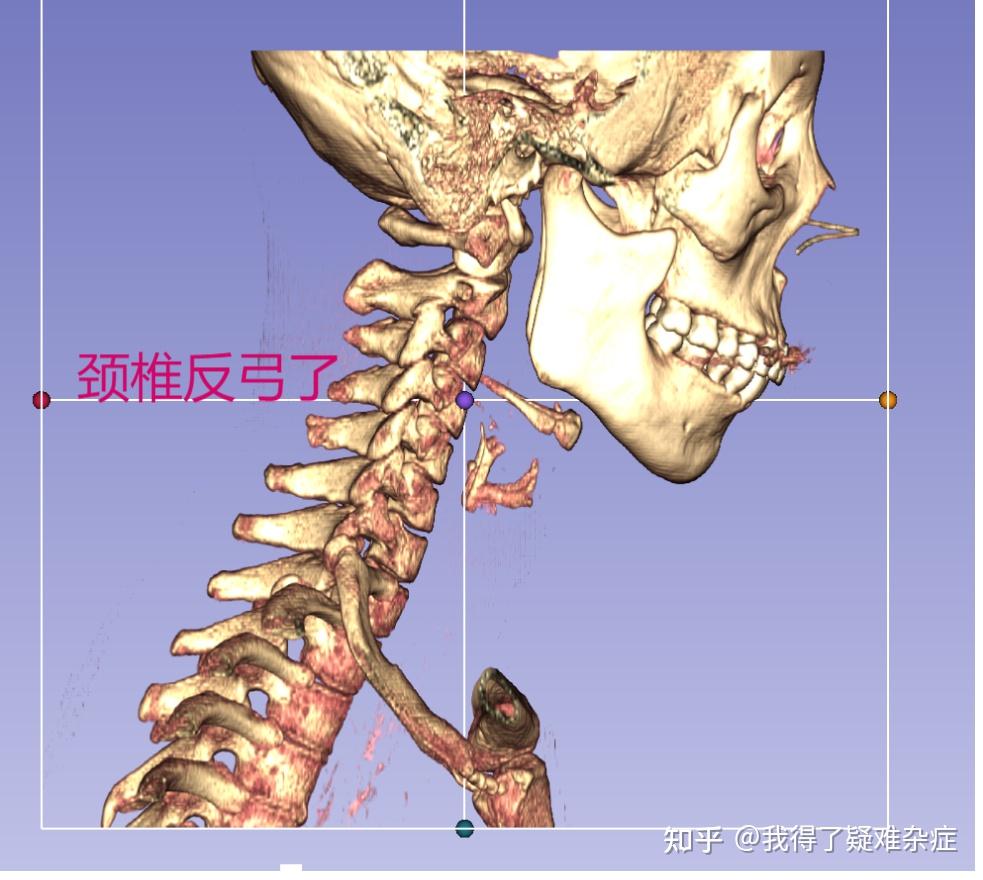 莫名其妙的疼痛人生-做了两次茎突过长截短手术 - 知乎
