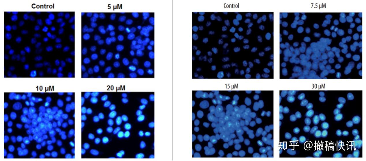 figure 2 利用dapi/pi染色检测骨肉瘤细胞saos-2凋亡.