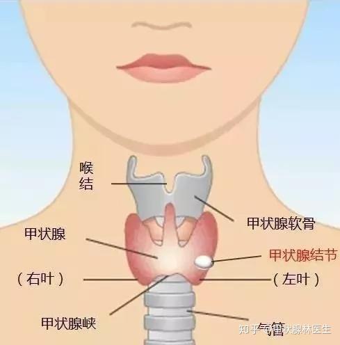 你知道吗 甲状腺乳头状癌是温和 善良的 知乎