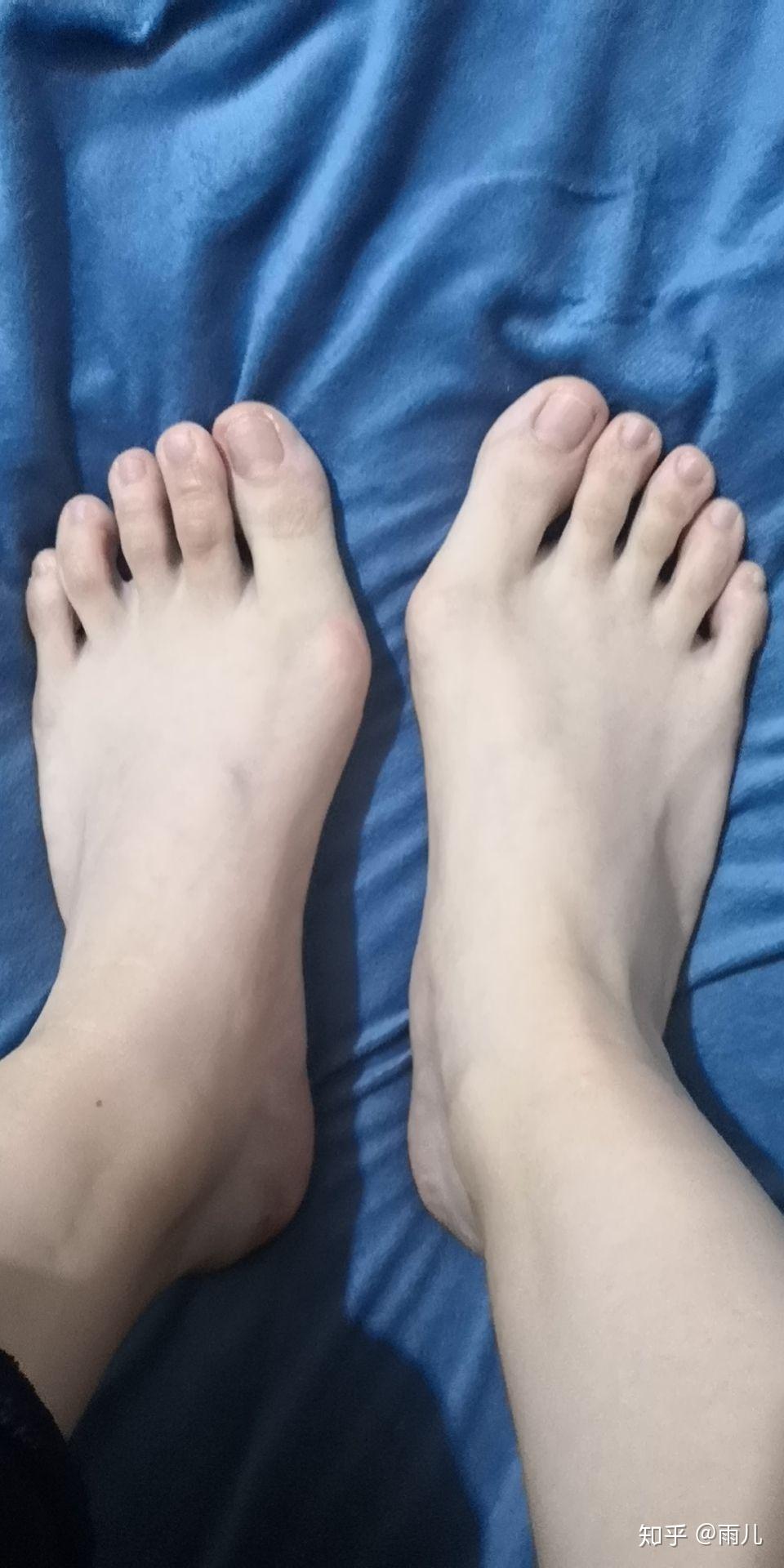 我的拇外翻大脚骨手术恢复过程