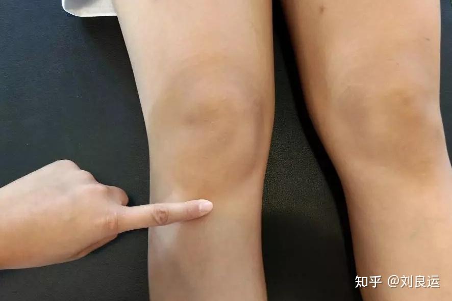 膝前痛不一定是膝骨关节炎,也可能是髌下脂肪垫炎,看看有啥特点
