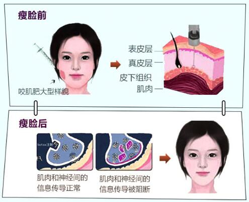 咬肌大就一定適合打瘦臉針嗎答案並非如此