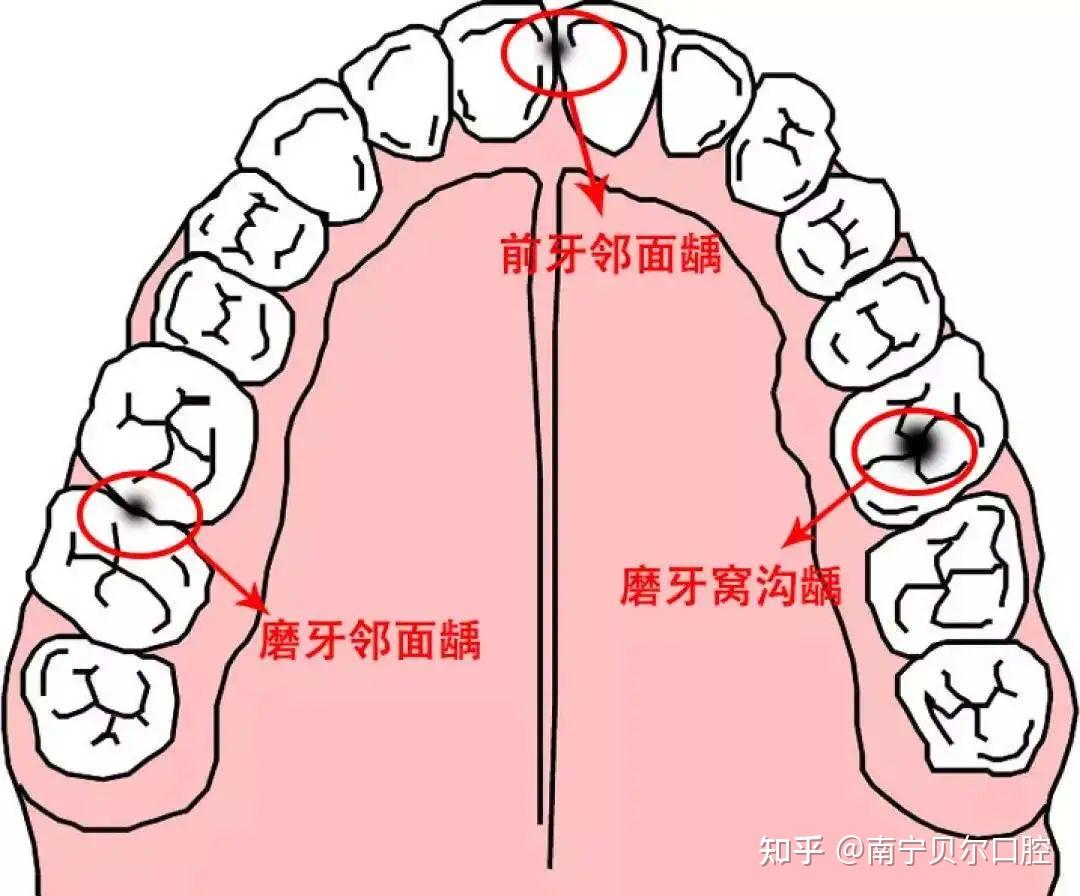 列拥挤和冠周炎的重要原因,还有一些阻生牙是颞下颌关节紊乱病的病因