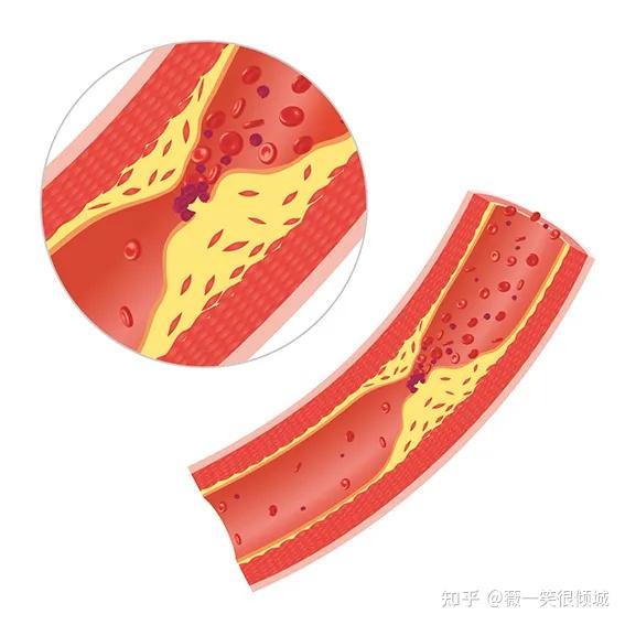这个动作每天坚持做20秒,让血管畅通无阻,告别得血栓的烦扰! - 知乎