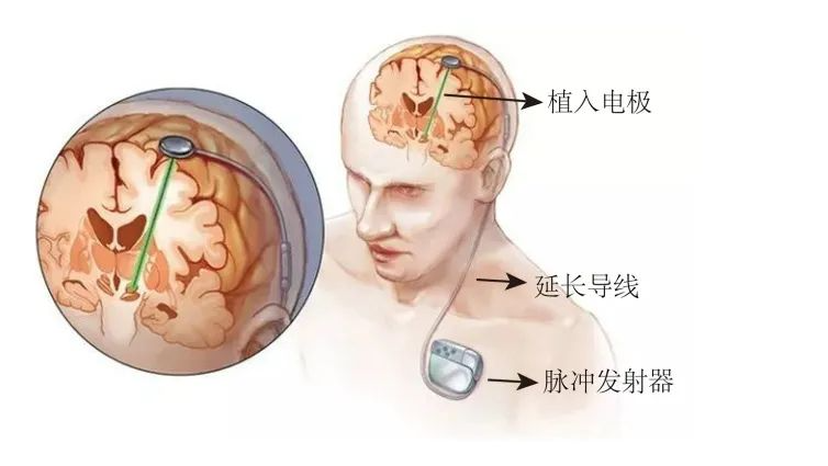 【世界帕金森病日】“黑科技”脑起搏器了解一下 - 知乎