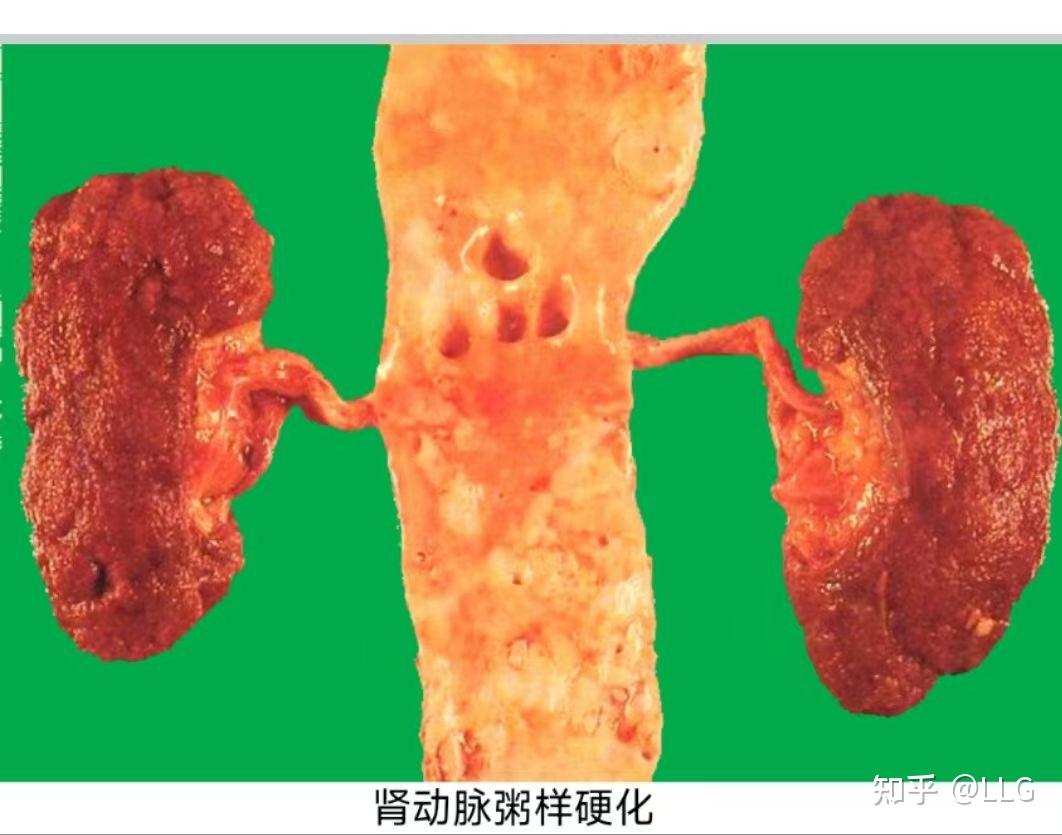 (二)肾动脉粥样硬化最常累及肾动脉开口处及主动脉近侧端,亦可累及叶