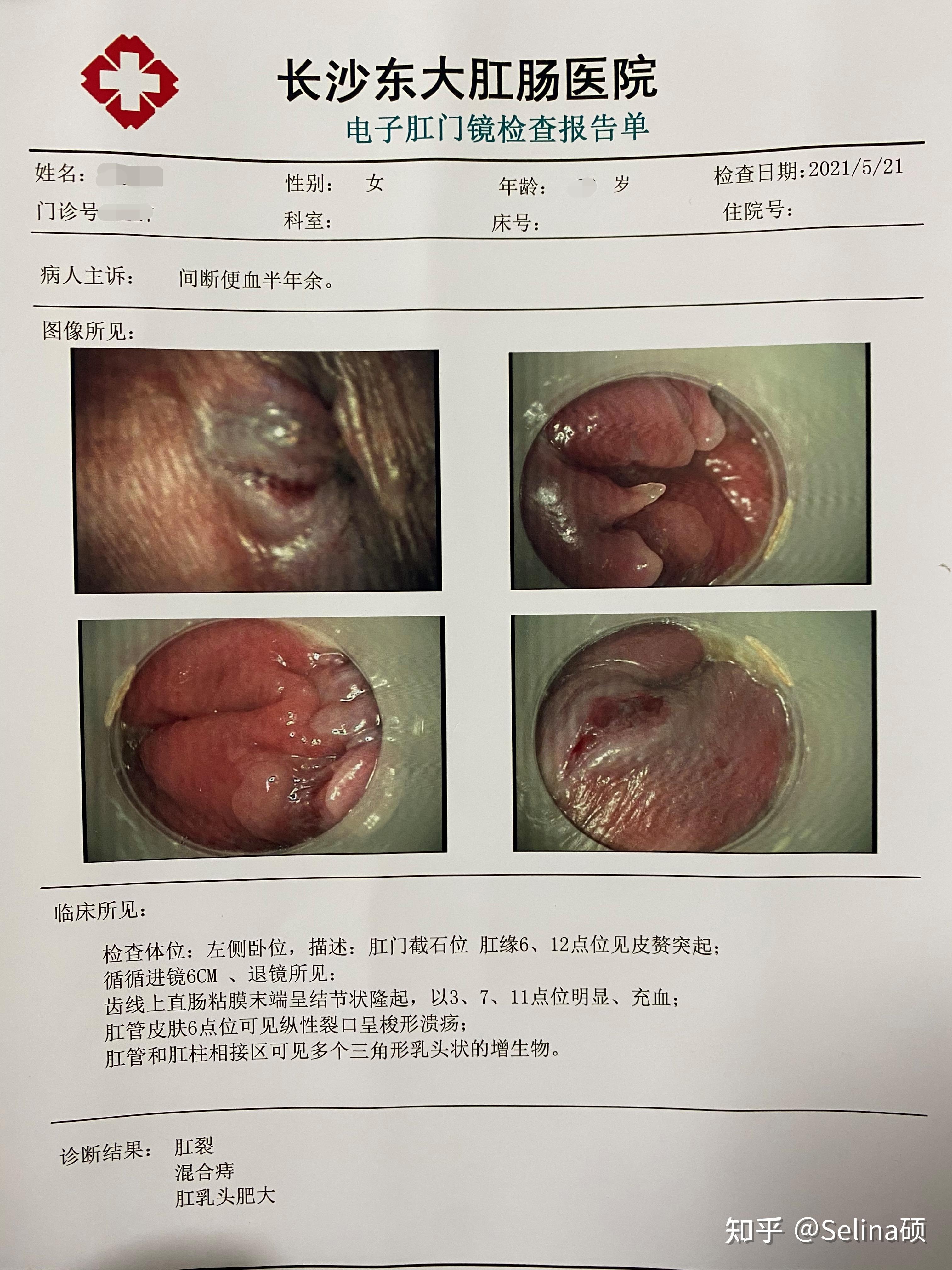 肛裂混合痔疮微创手术远离私立医院