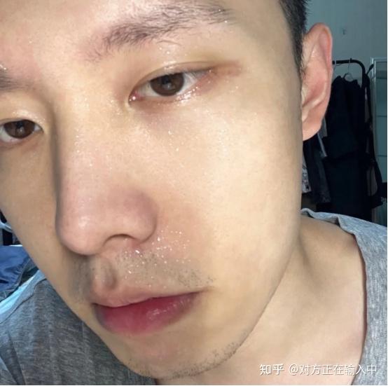 男生脸上总是泛油爆痘怎么办