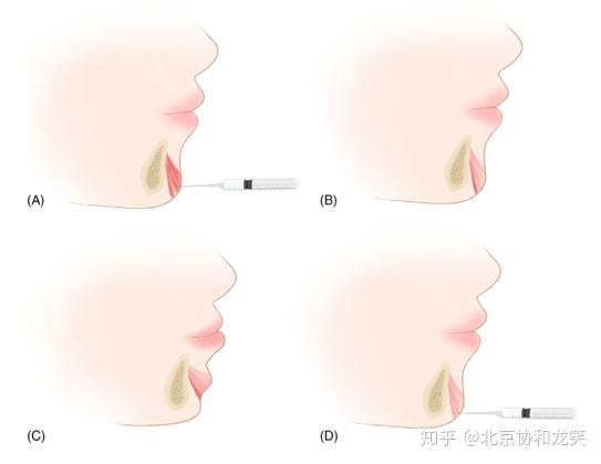 颏肌放松注射位置图片