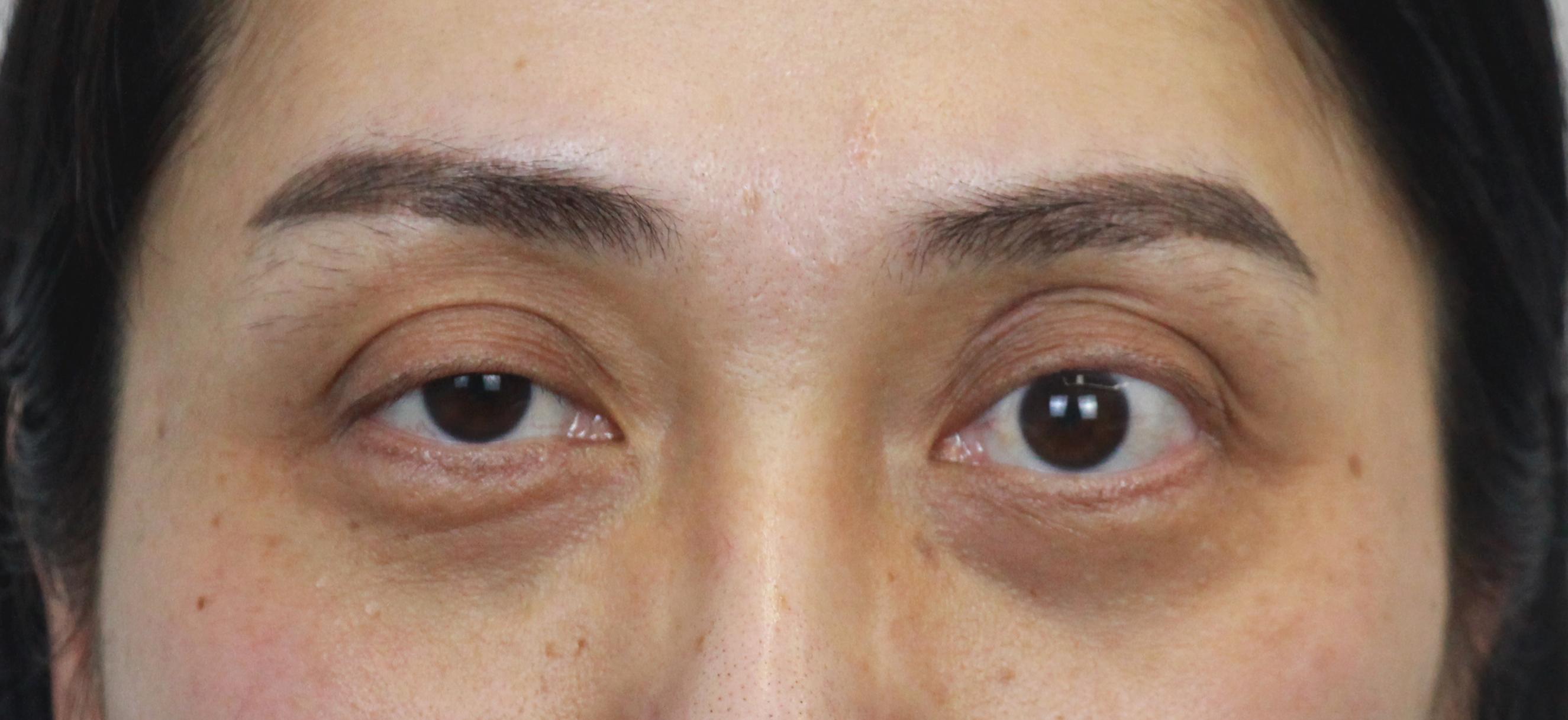 近视+眼窝凹陷，上睑脂肪填充很重要-刘野-爱问医生