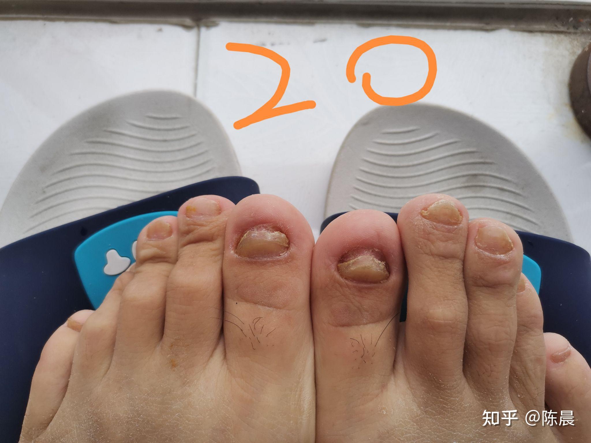 肝功能正常2021/06/07:今早起来喷了达克宁,发现大脚趾指甲从里面