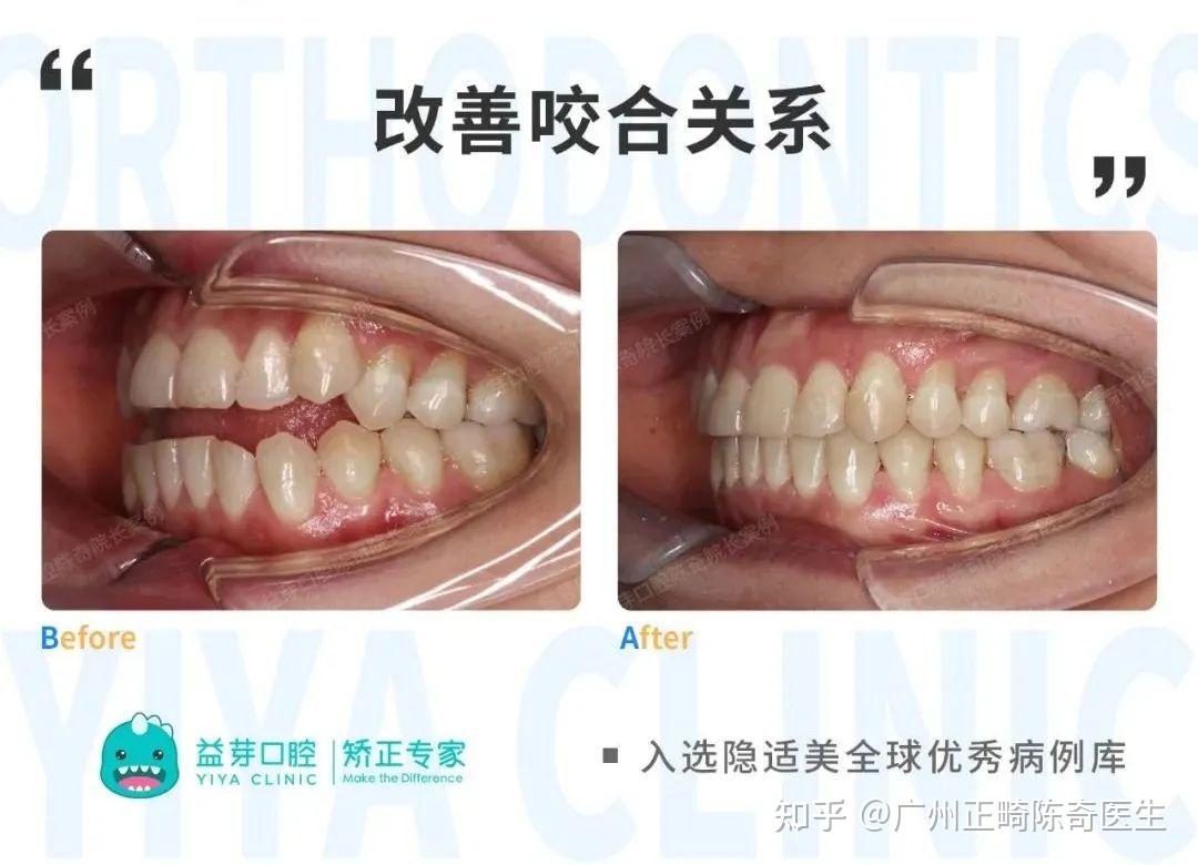 国际优秀案例640天解决开颌完成100分完美咬合