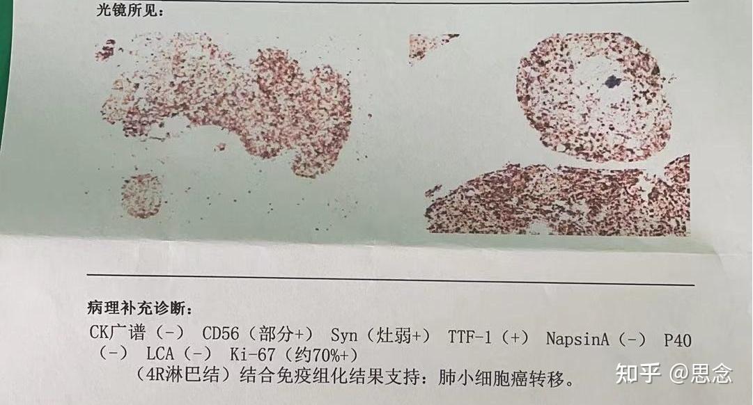 確診小細胞肺癌5正式確診