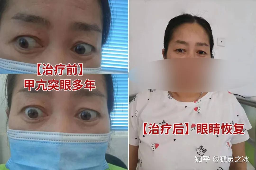 甲亢好了突眼也好了?甲亢突眼怎么治?一文看懂甲状腺相关性眼病 - 知乎