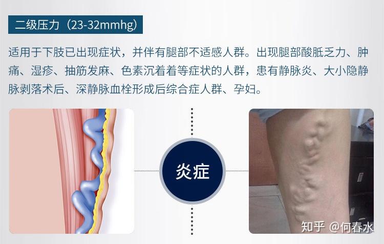 为什么穿上弹力袜后感觉静脉曲张更严重了? - 知乎