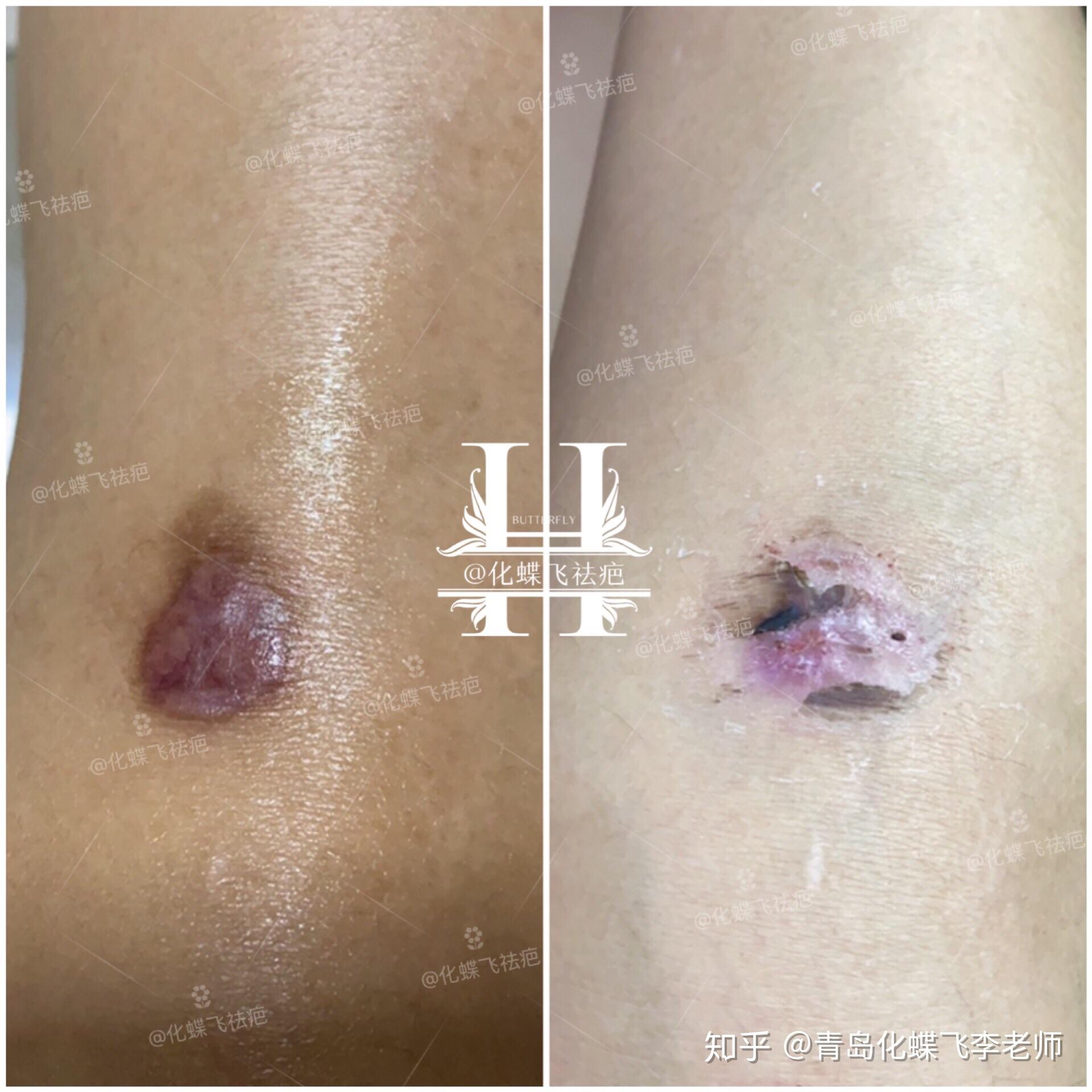 浙江湖州,美女艾灸烫伤留下了增生疤痕.颜色紫红,还能看到明显红血丝.