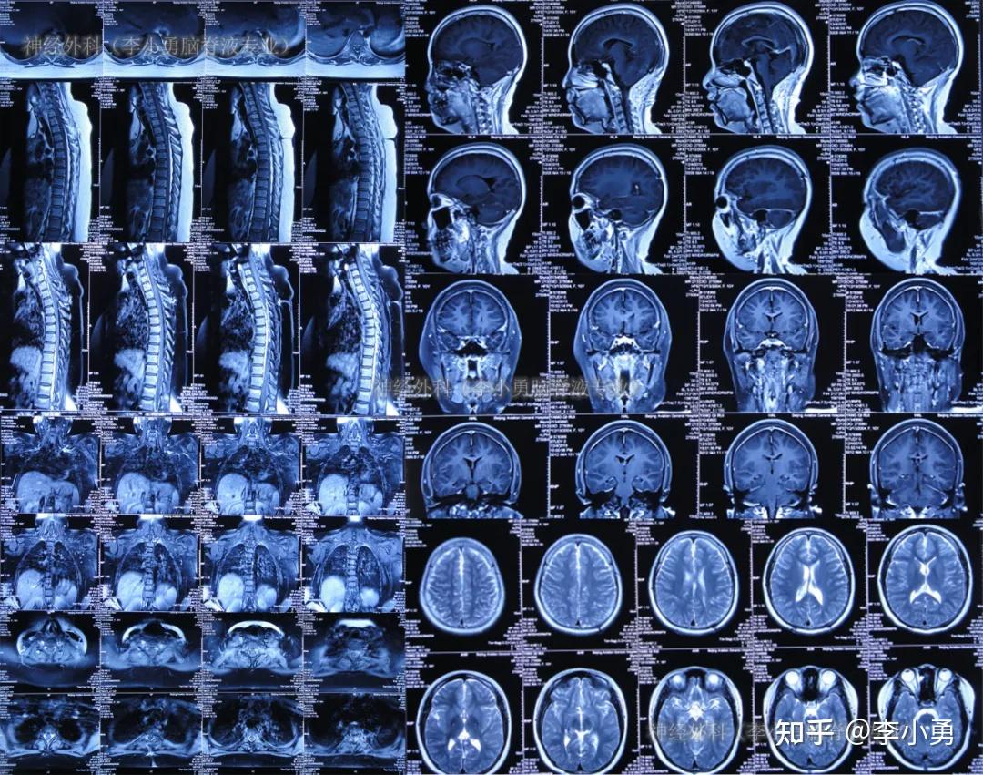 图-34:脊髓颅脑核磁期间患儿短暂出院后又再次住院,继续治疗有1年余