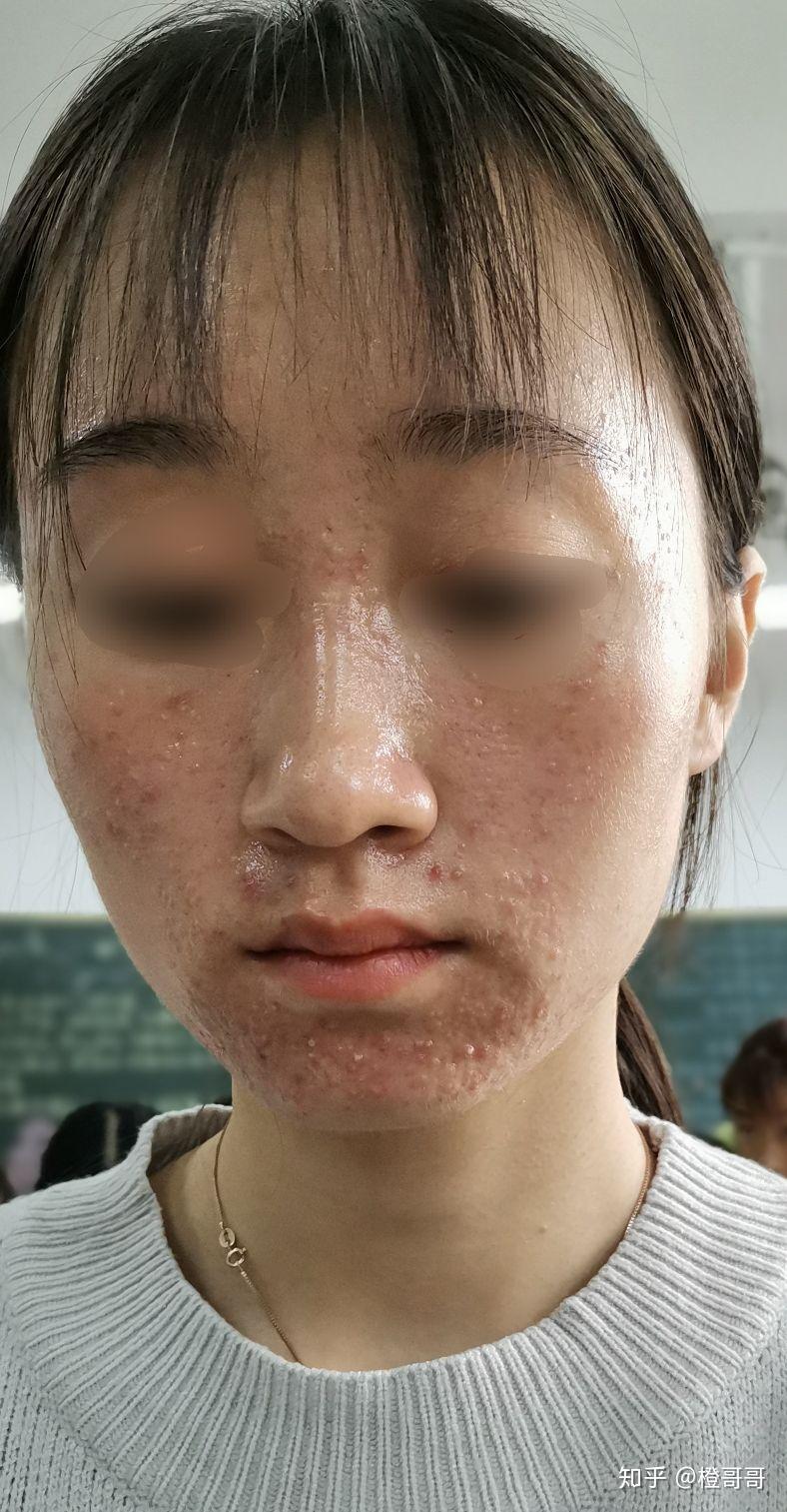 阿达帕林治闭口粉刺的经历 - 知乎