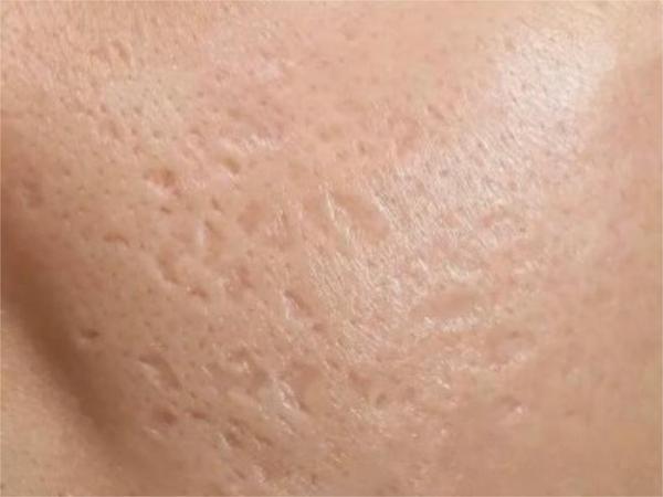 男生一脸痘坑真的没救了吗?皮肤科医生总结2000+典型案例:3步解决万年老痘坑!【45天】显著改善,男生皮肤平滑紧致、滑溜溜! - 知乎
