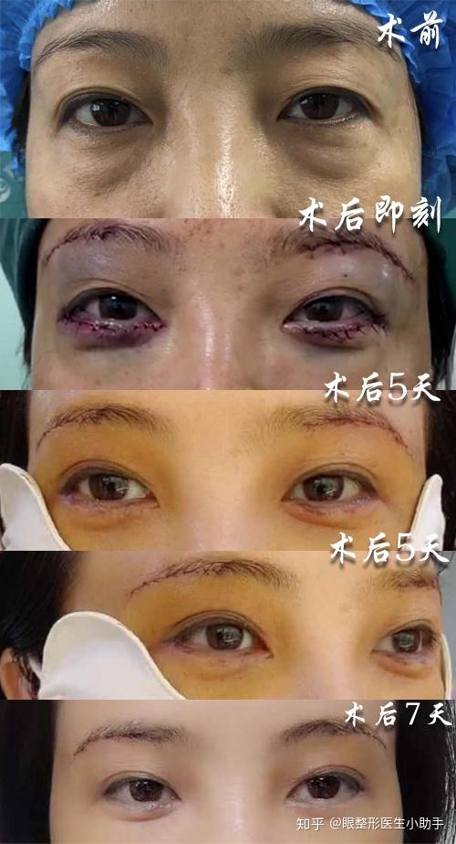 祛眼袋手术哪儿做的好