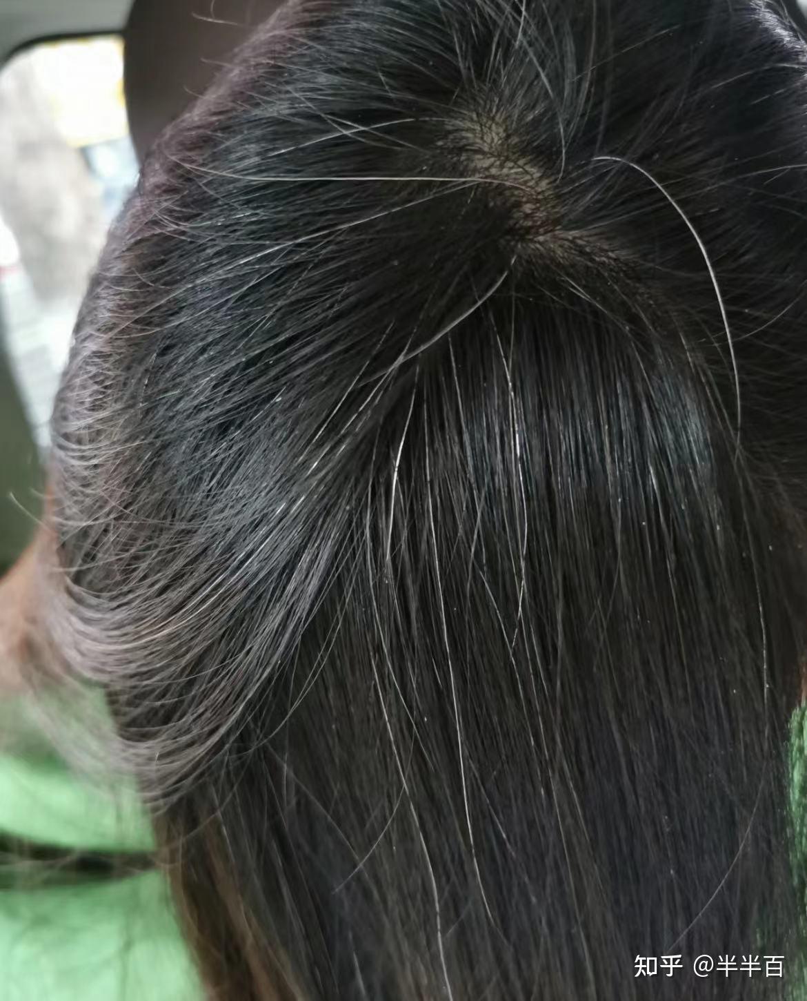 有没有人有过白发变黑的经历,是用什么办法变黑的呢?