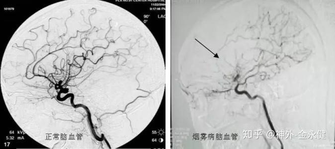 烟雾病是什么病?该如何治疗? - 知乎