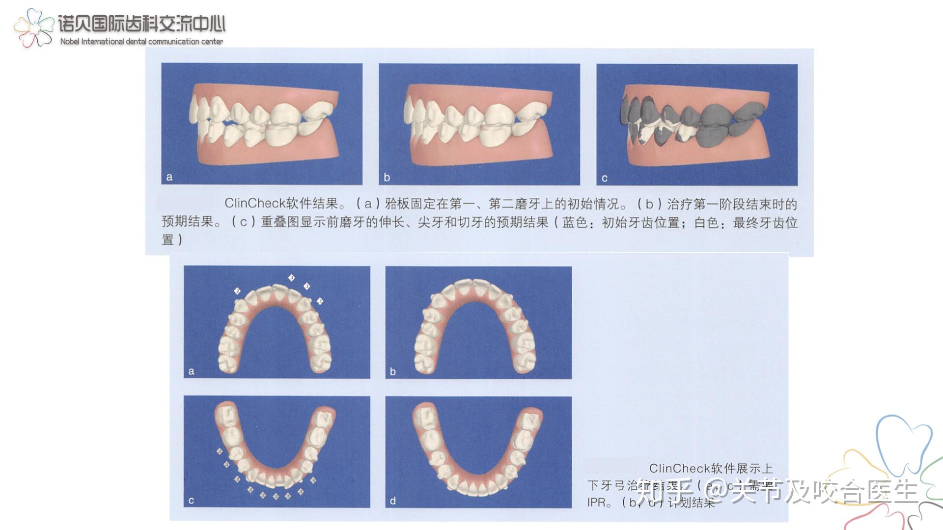 mini splints 局部咬合板對顳下頜關節髁突及