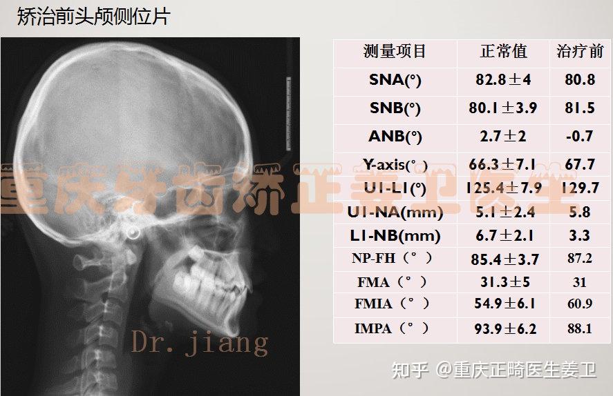 安氏Ⅱ類 毛氏Ⅲ2 類骨性Ⅲ類中線不齊雙側後牙反頜骨53滯留,13阻生顏