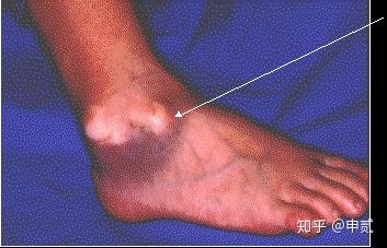 你了解骨折吗 知乎