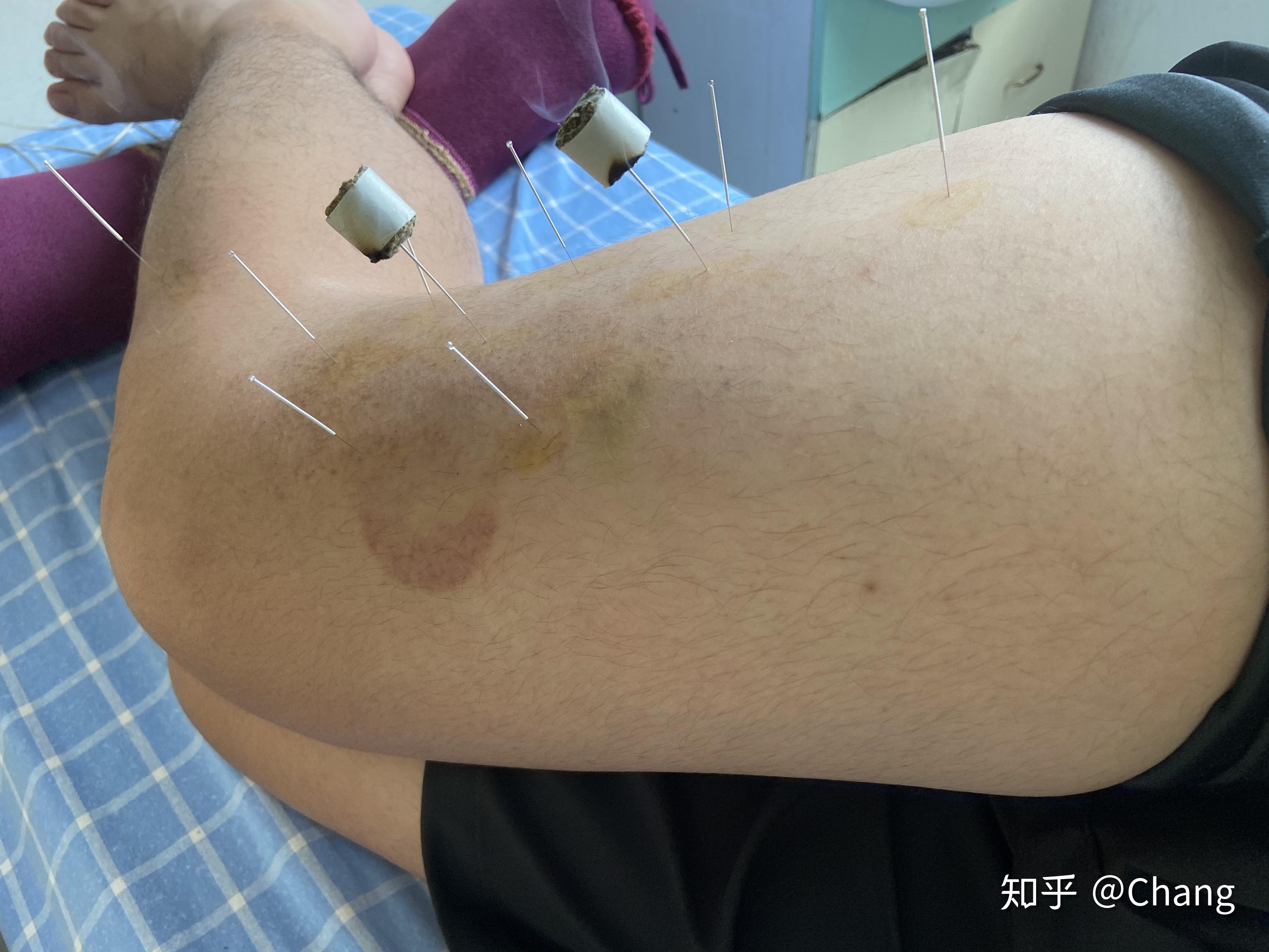 做个股外侧皮神经炎治疗日记吧 - 知乎