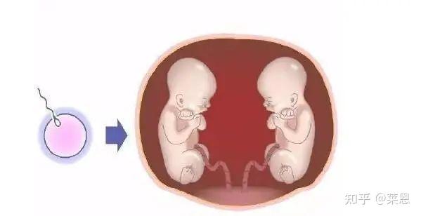发生率十万分之四,存活率50%的单绒单羊双胞胎