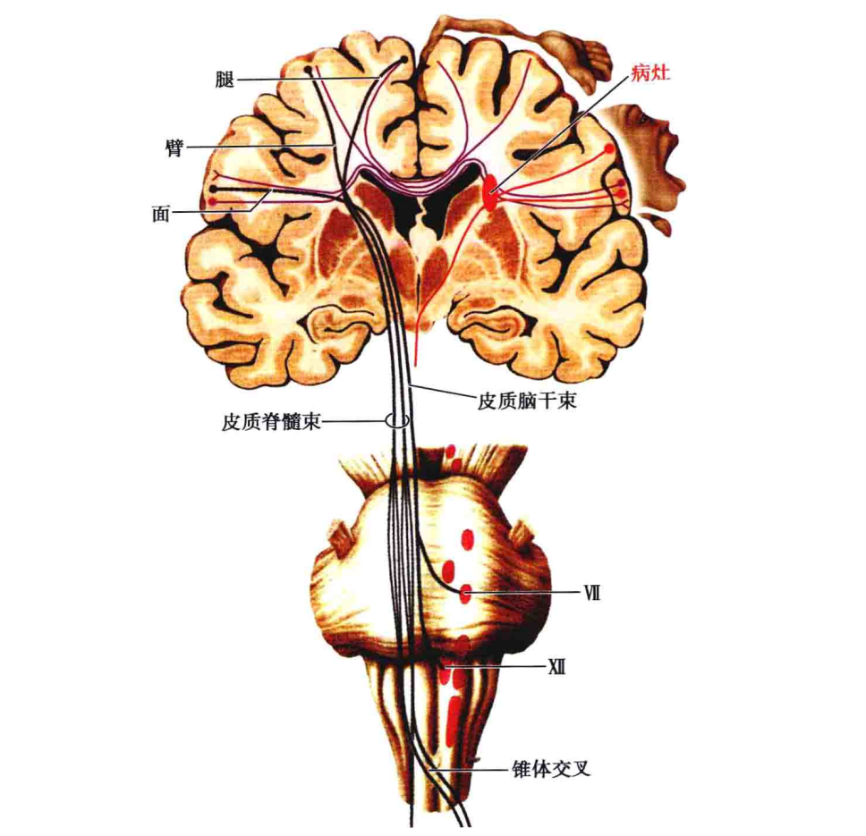 神内临床笔记11 胼胝体病变 - 知乎