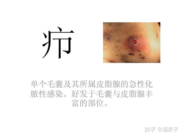 疖、痈的主要致病菌？为什么面部，尤其是危险三角区的疖、痈不宜挤压？ - 知乎