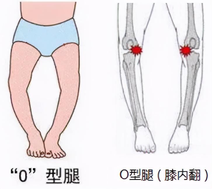 o型腿的救星 胫骨外翻截骨术