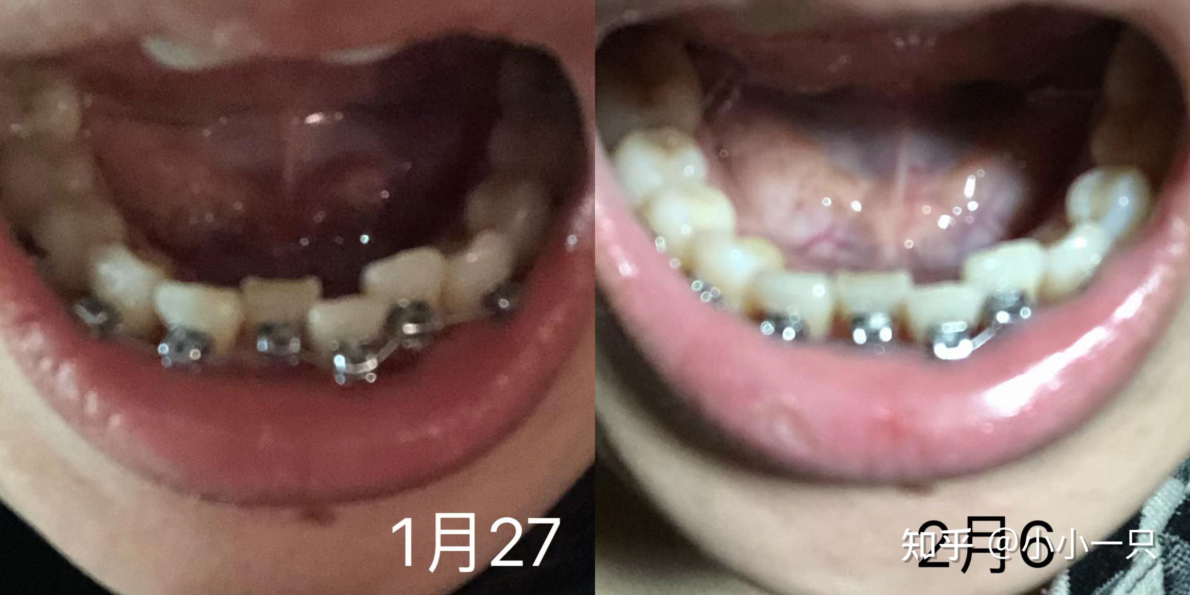 34岁开始整牙记 - 知乎