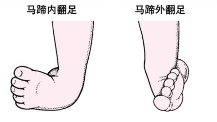 并且长期足内翻,外翻也容易诱发膝关节的内外翻,即x型和o型腿的发生
