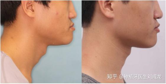 坐标郑州求推荐地包天矫正效果比较好的医生