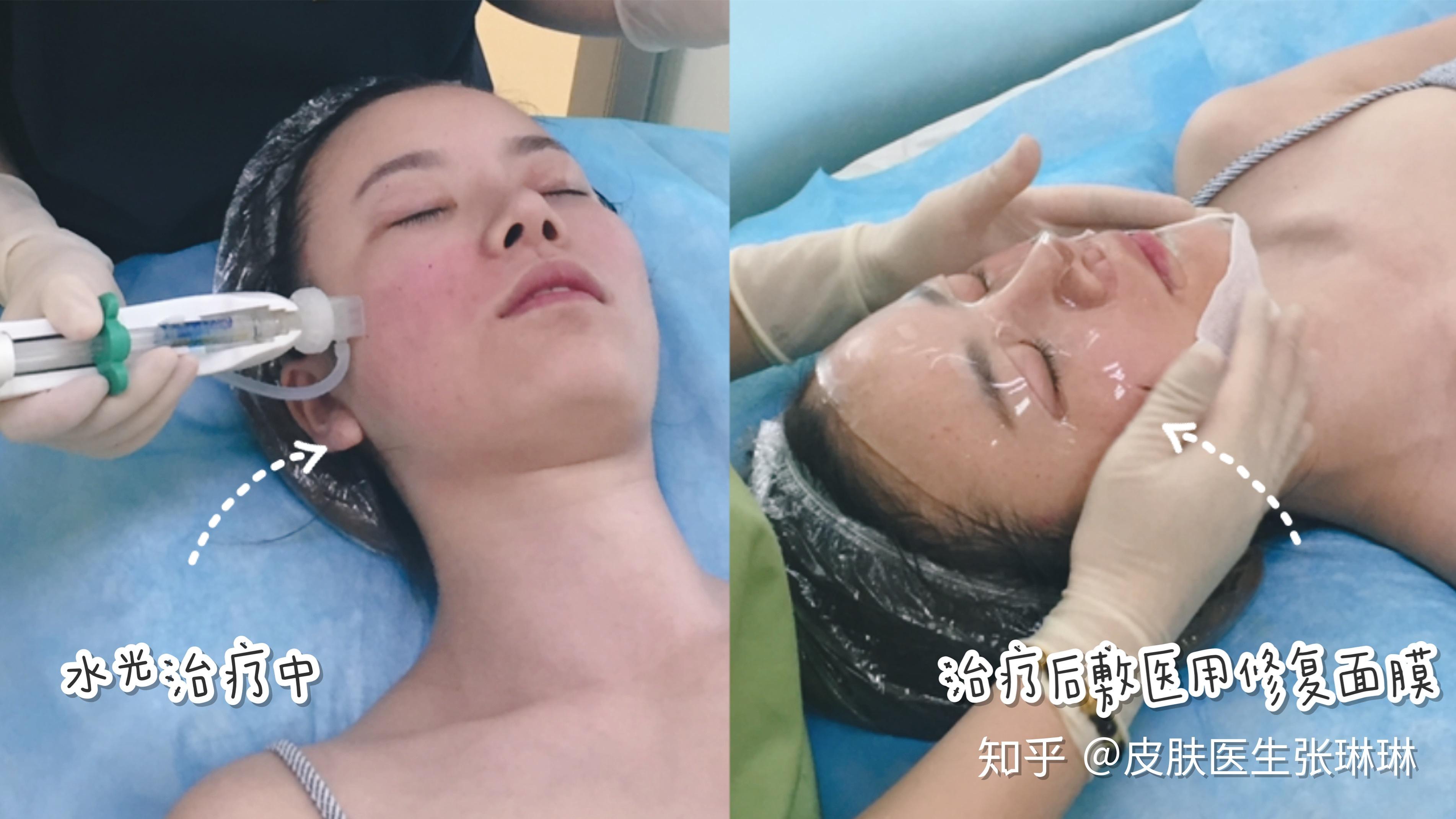【皮肤医生告诉你】被称为医美入门级项目——水光针! - 知乎