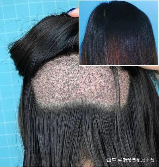 什么是剃发植发？效果如何？优劣势？价格大概是多少？ - 知乎