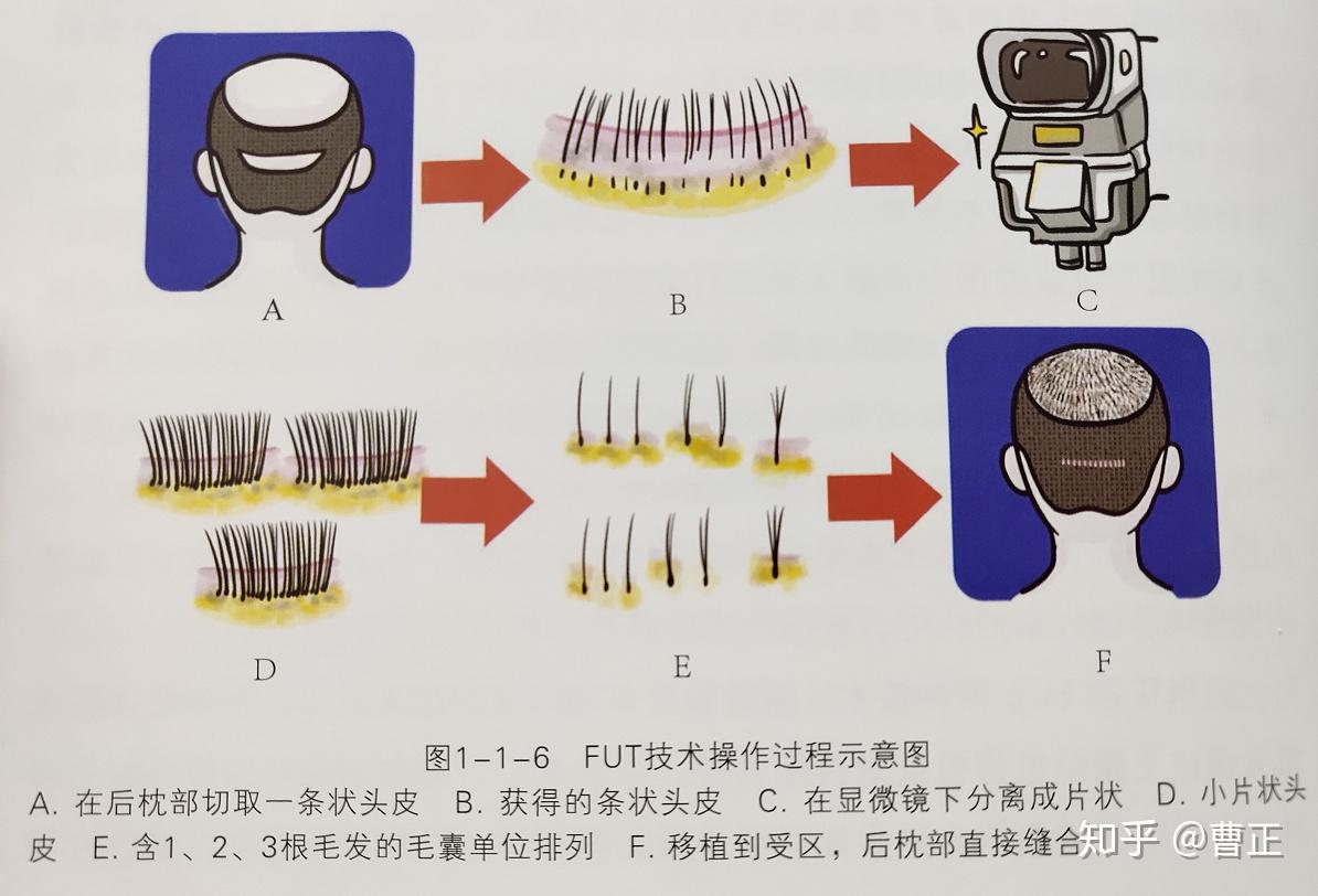 [项目展示]自体毛发移植技术在儿童毛发缺损治疗中的规范化应用 中国基层卫生人才数据库