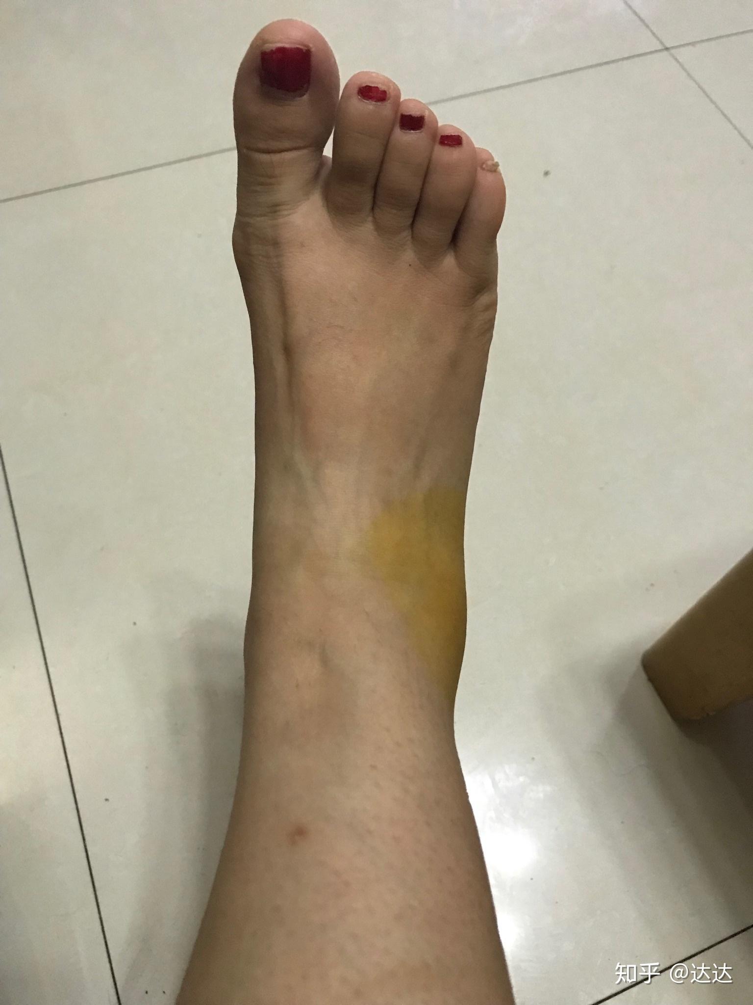 脚踝扭伤全记录
