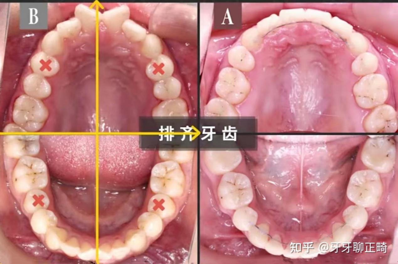 医生一次拔掉我4颗好牙很可惜,为啥牙齿矫正一定让我拔牙呢 知乎